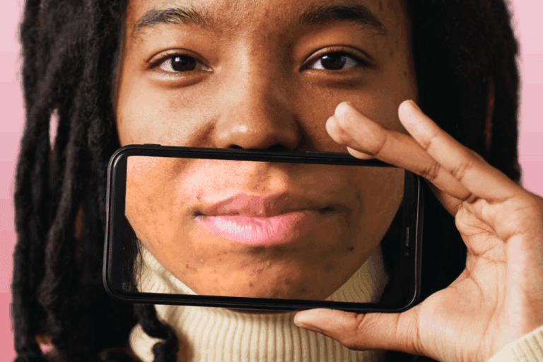 Woman with acne holds up phone in front of her face with an image of her mouth on the screen