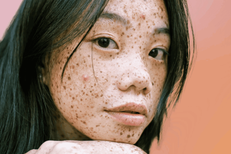 Woman with freckles and a couple of pimples looks at camera