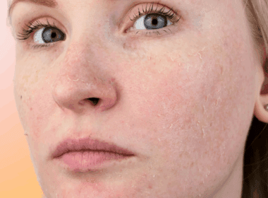 Woman with peeling skin