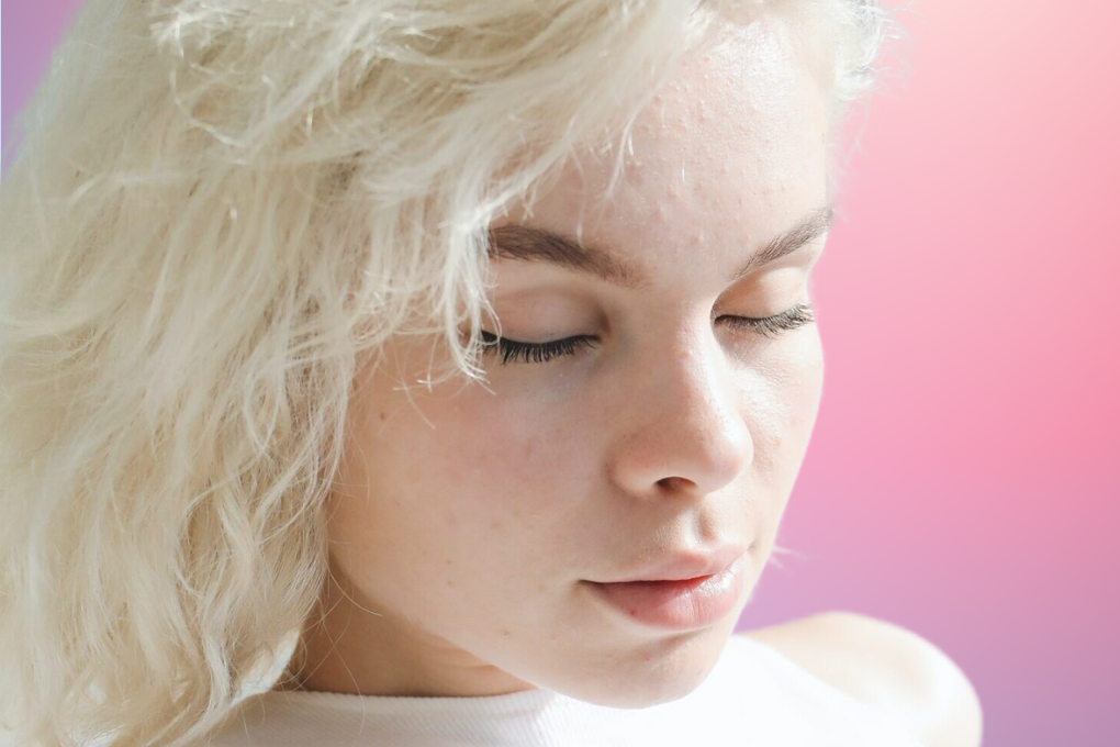 Photo of a woman with clogged pores