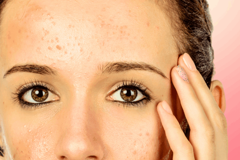 Woman with small pimples on forehead