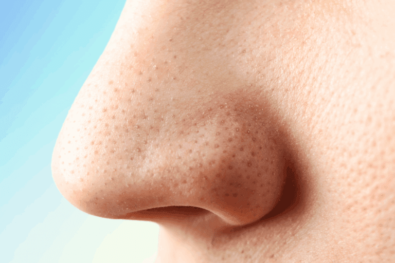 Photo of sebaceous filaments