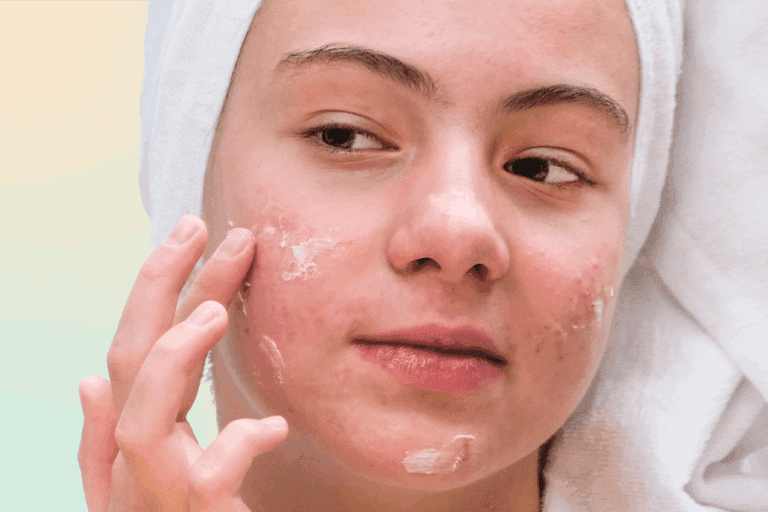 Woman with acne applying moisturizer