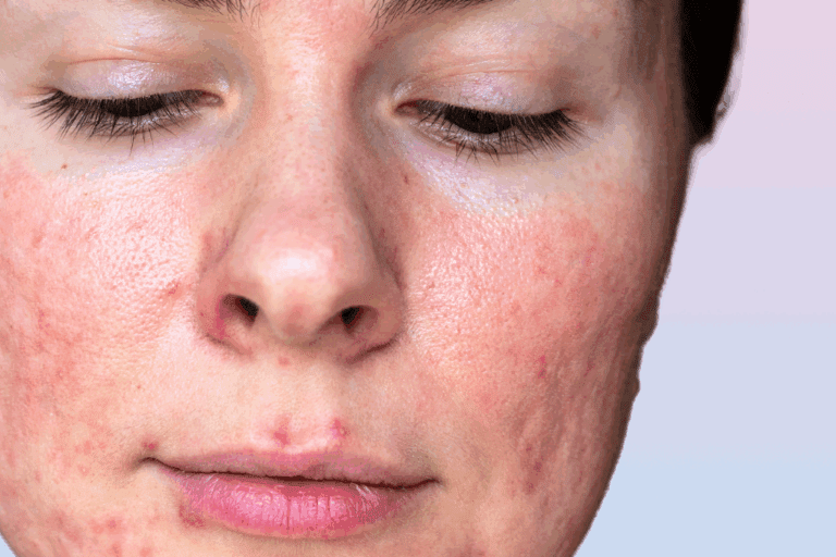 Woman with pustules from rosacea