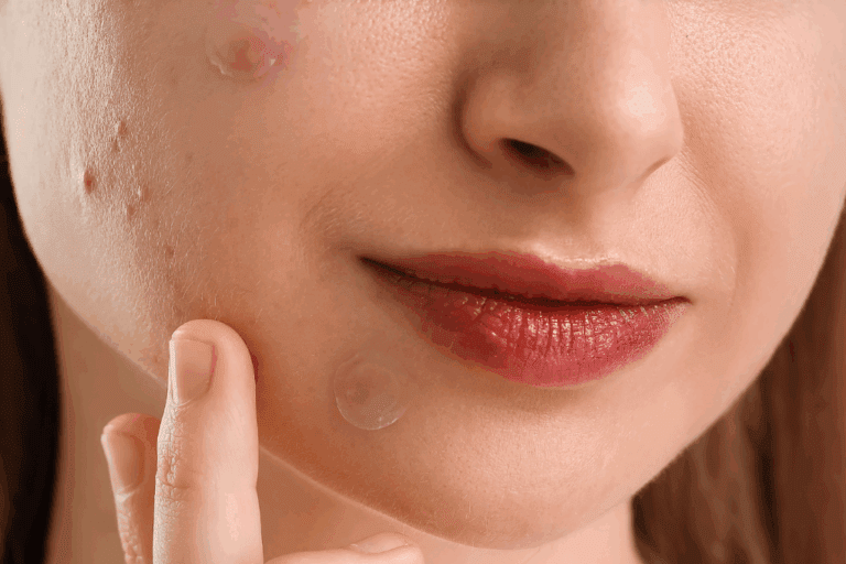Woman wearing pimple patches