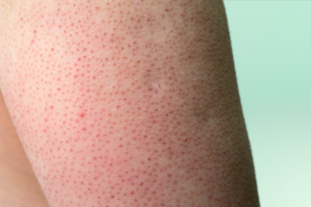 Red bumps on the back of arm