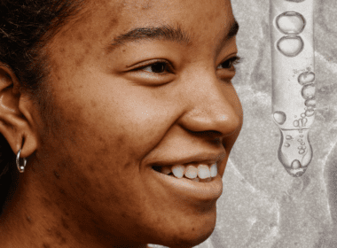 Woman with hyperpigmentation and a serum dropper