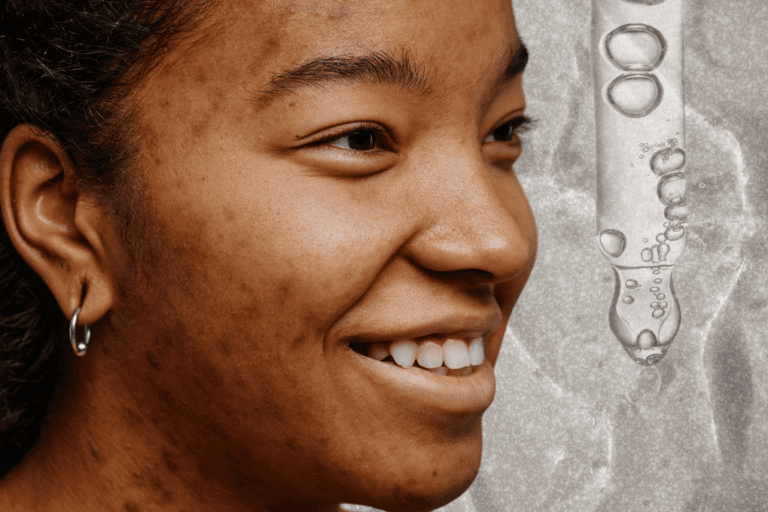Woman with hyperpigmentation and a serum dropper
