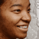 Woman with hyperpigmentation and a serum dropper