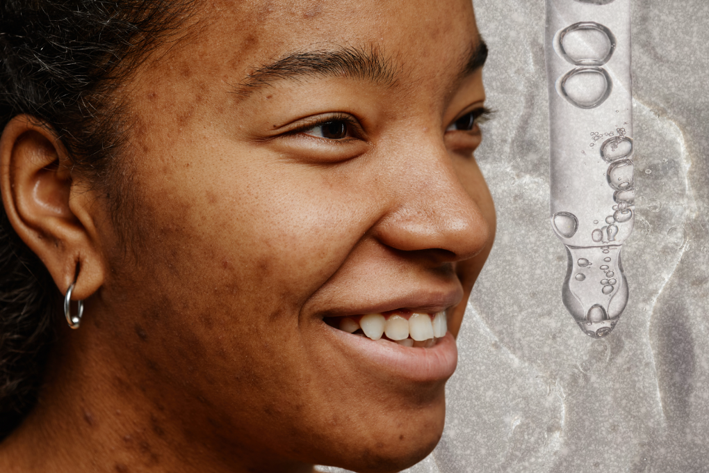Woman with hyperpigmentation and a serum dropper