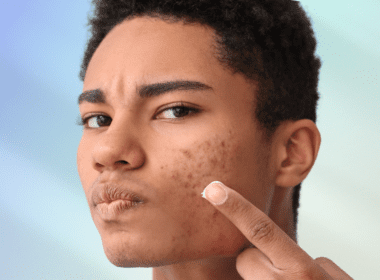 Man with acne about to apply a cream product to face