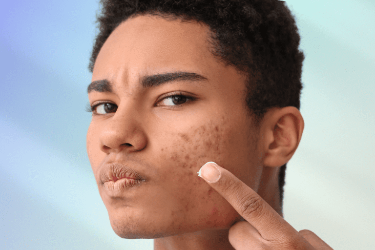 Man with acne about to apply a cream product to face