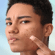 Man with acne about to apply a cream product to face