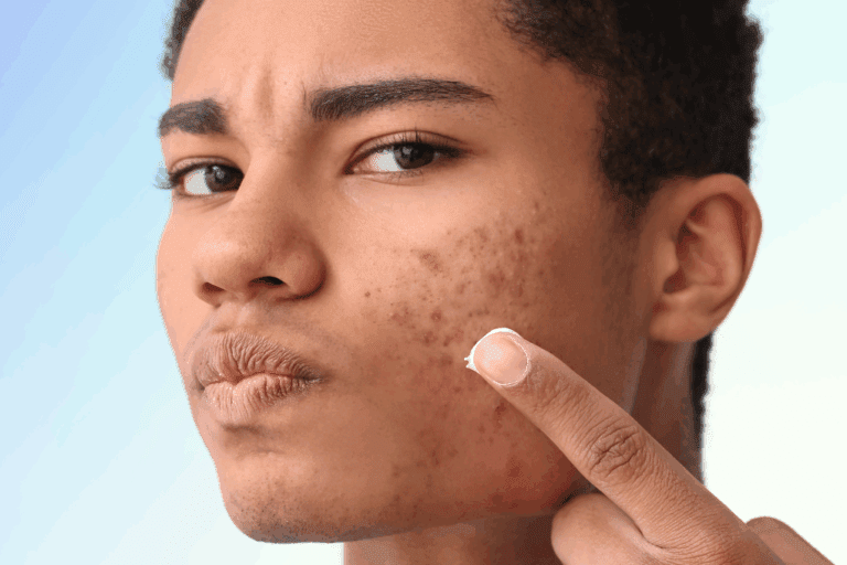 Man with acne about to apply a cream product to face