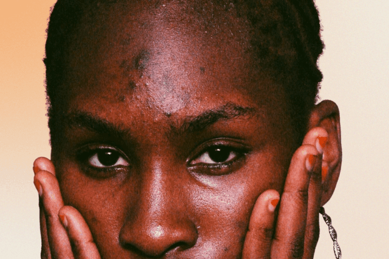 Woman with hyperpigmentation